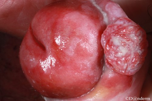 9-23-3_Squamous_cell_carcinoma