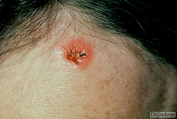 7-91-1_Basal_cell_carcinoma_-_nodular