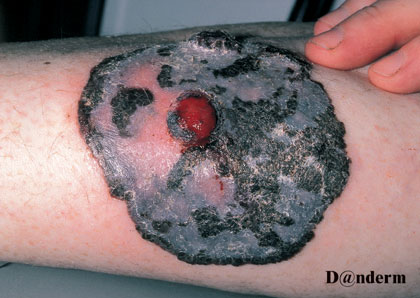 7-170_Malignant_melanoma_-_nodular