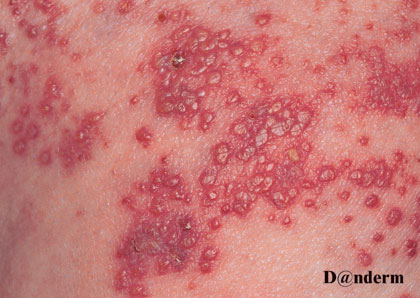 8-83_Herpes_zoster_(2_of_2)