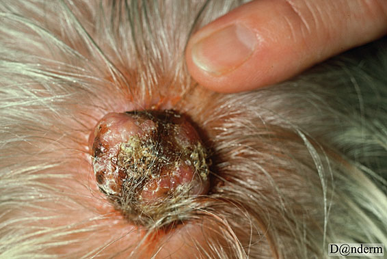 7-92-1_Basal_cell_carcinoma_of_the_scalp