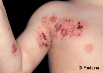 8-78_Herpes_zoster_in_a_child_(1_of_2)