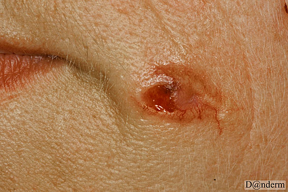 7-91-9_Basal_cell_carcinoma_-_nodular