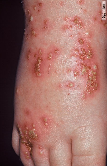 2-106-2_Atopic_dermatitis_with_bacterial_infection