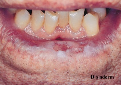 7-120_Squamous_cell_carcinoma_on_the_lower_lip