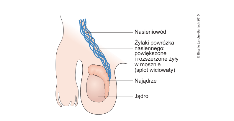 Żylaki powrózka nasiennego Grafika penisa z nasieniowodem oraz jądrem