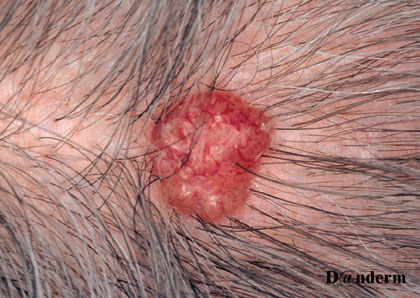 7-92_Basal_cell_carcinoma_of_the_scalp