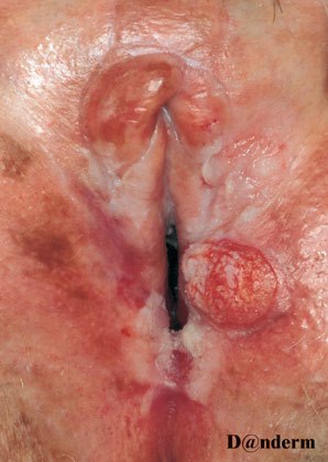 6-88_Lichen_sclerosus_et_atrophicus_with_squamous_cell_carcinoma