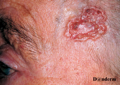 7-94_Basal_cell_carcinoma