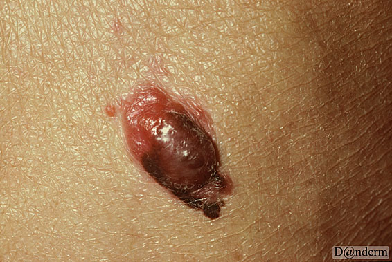 7-167-10_Malignant_melanoma_nodular