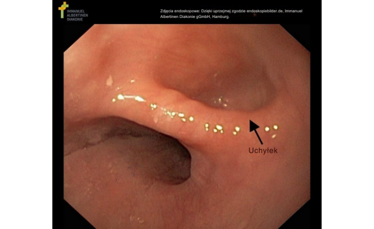 Uchyłek przełyku Przełyk, uchyłek, światło