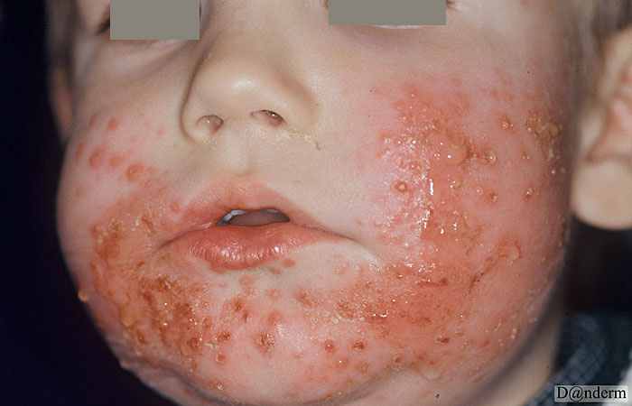 2-108-1-2_Atopic_dermatitis_with_simultaneous_primary_herpes_simplex_infection