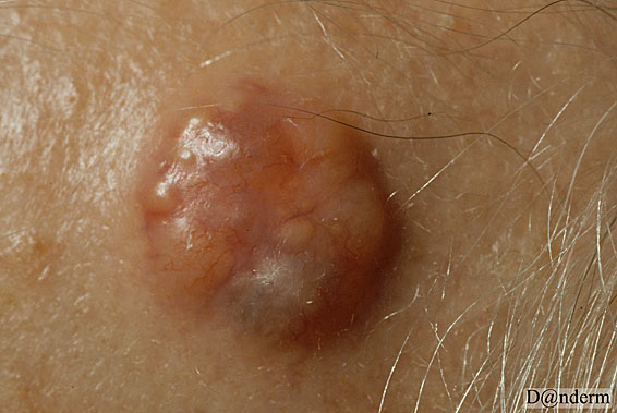 7-91-8_Basal_cell_carcinoma_-_nodular_(2_of_2)