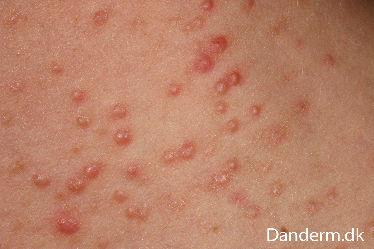 4-132-7_Acne_aestivalis_5_of_5