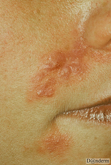 4-146-9_Periorificial_dermatitis