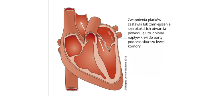 Zwężenie zastawki aortalnej (stenoza aortalna) Przekrój serca, zastawka aortalna, komory.