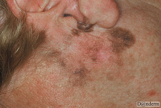 7-156-b_Lentigo_maligna