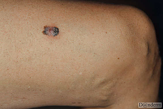 7-167-7_Malignant_melanoma_nodular