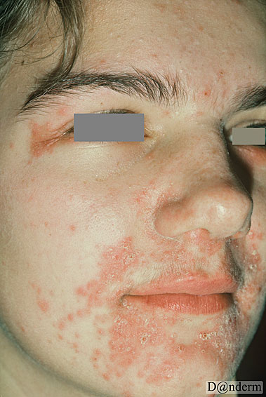 4-146-2_Periorificial_dermatitis