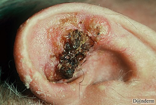 7-119-4_Squamous_cell_carcinoma_on_the_ear