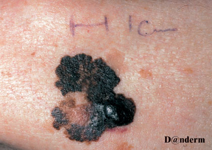 7-168_Malignant_melanoma_-_nodular