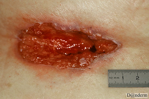 7-95-2_Basal_cell_carcinoma_nodular_ulcerated