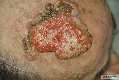 7-119-2_Squamous_cell_carcinoma_on_the_scalp