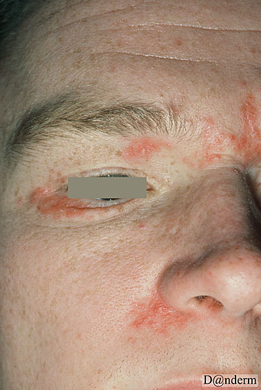 4-146-5_Periorificial_dermatitis