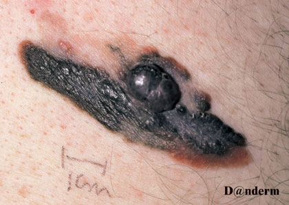 7-169_Malignant_melanoma_-_nodular