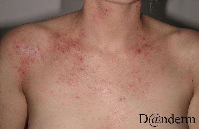 2-108-48_Atopic_dermatitis_1_of_2(Also_in_large_size)