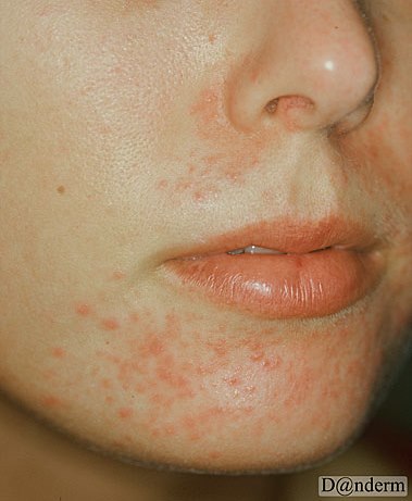 4-146-4_Periorificial_dermatitis