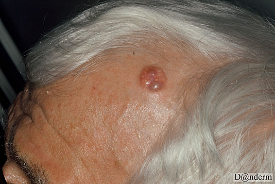 7-91-7_Basal_cell_carcinoma_-_nodular_(1_of_2)