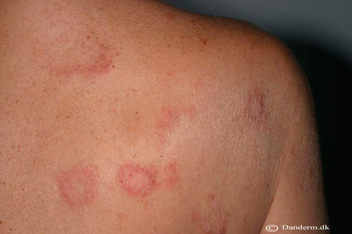 2-123-2_Nummular_eczema_of_the_back_2_of_2