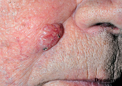 7-91_Basal_cell_carcinoma_-_nodular