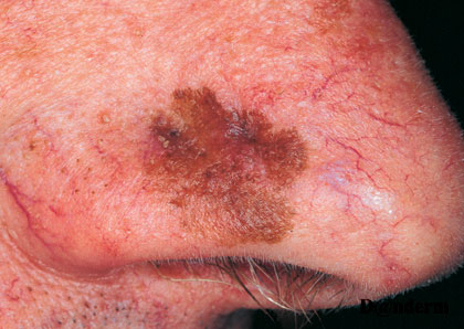 7-155_Lentigo_maligna