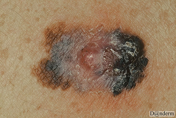7-167-5_Malignant_melanoma_nodular