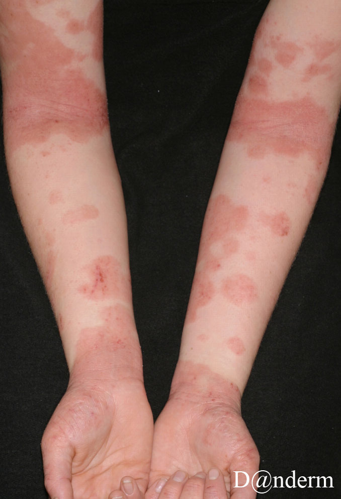2-108-4_Atopic_dermatitis_2_of_2