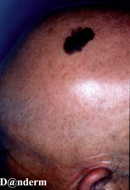 7-159-1_Malignant_melanoma,_superficial_spreading_(1_of_2)