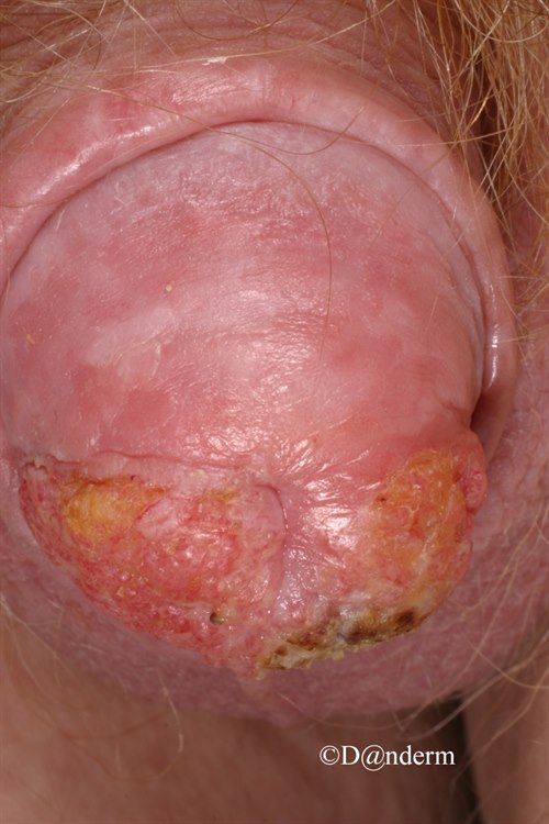 9-23-1_Squamous_cell_carcinoma