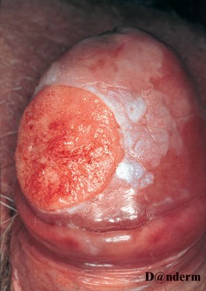 9-23_Squamous_cell_carcinoma