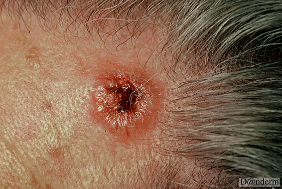 7-91-2_Basal_cell_carcinoma_-_nodular