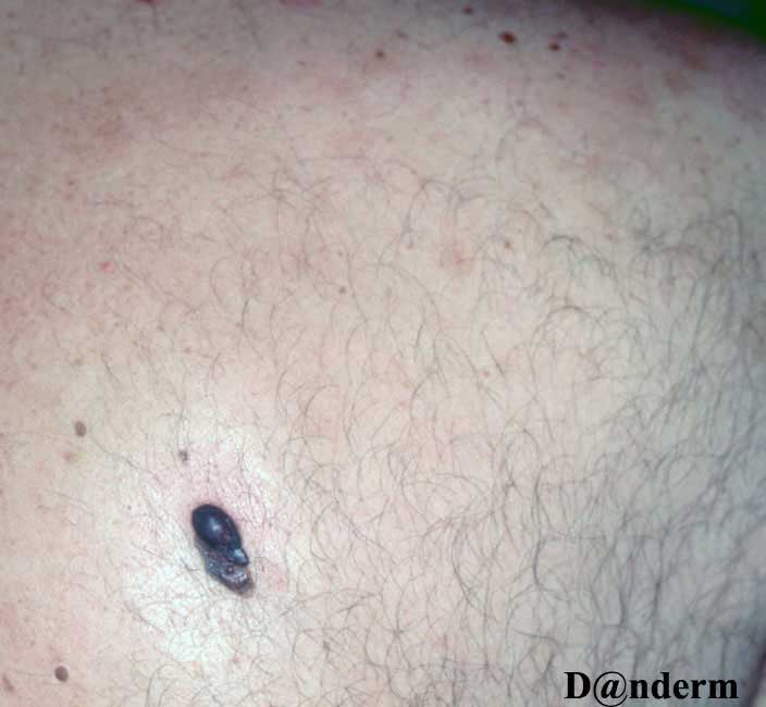 7-167-1_Malignant_melanoma,_nodular_(1_of_2)