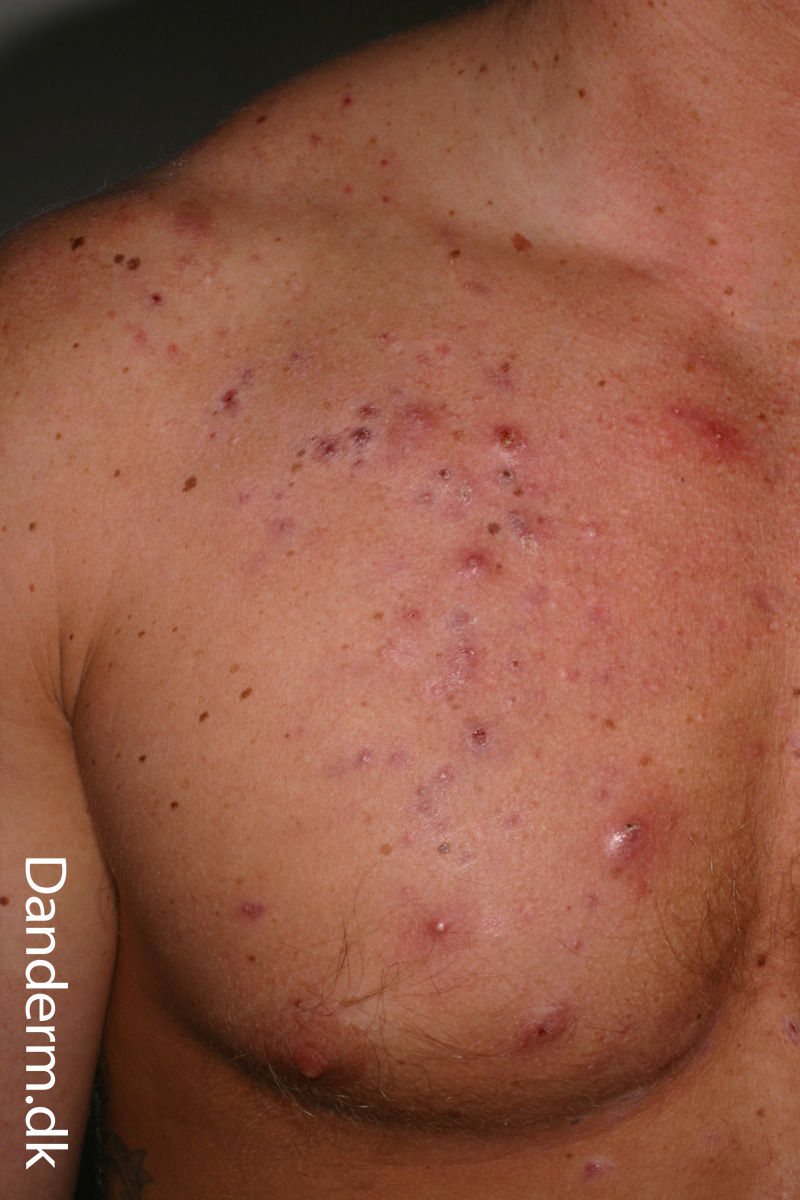 4-120-13_Acne_following_use_of_hormones_in_a_fitness_center