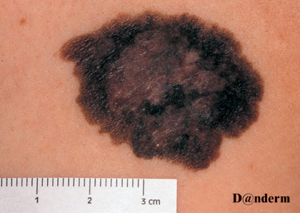 7-161_Malignant_melanoma_(2_of_2)
