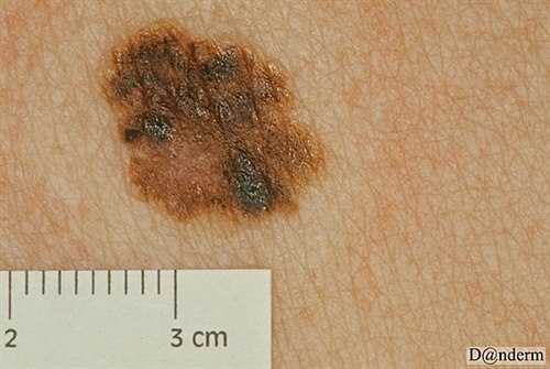 7-159-7_Malignant_melanoma_superficial_spreading
