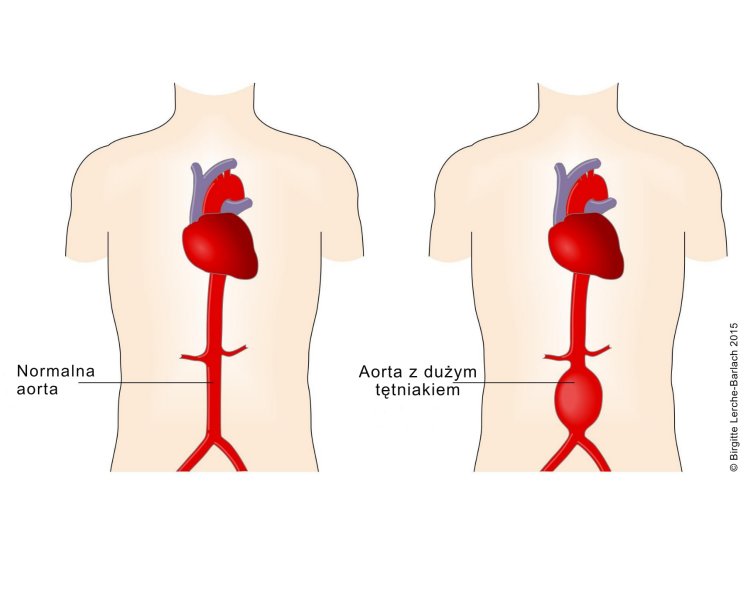 Tętniak aorty brzusznej ilustracja aorta bez tętniaka i z dużym tętniakiem