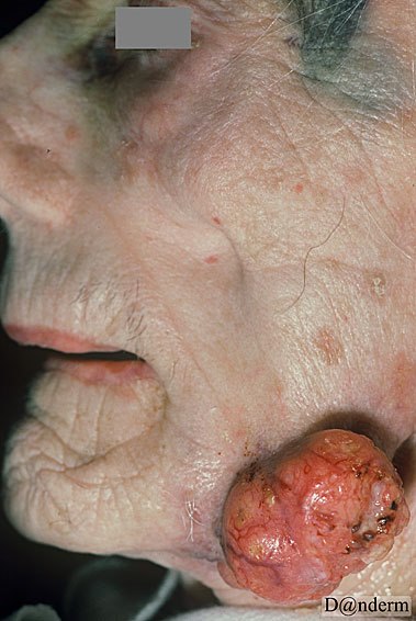 7-119-3_Squamous_cell_carcinoma_on_the_cheek