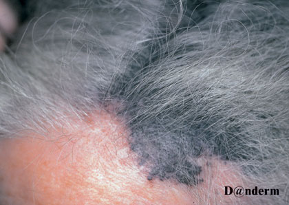 7-166_Malignant_melanoma