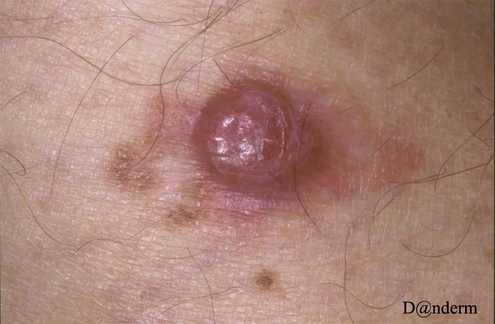 7-167-4_Malignant_melanoma_with_little_pigment_(2_of_2)