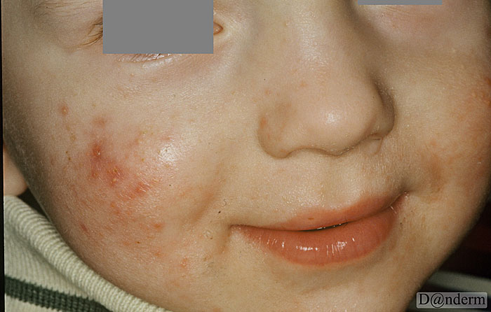 4-116-2_Acne_neonatorum